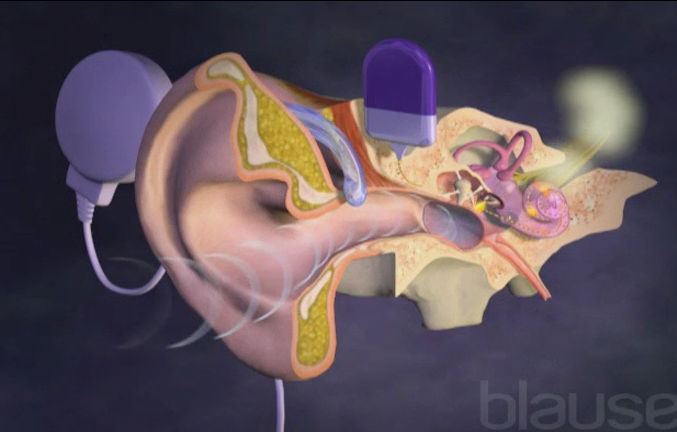 Implants cochléaires - curic.ch