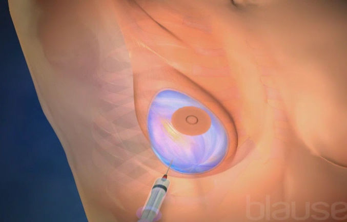 Augmentation mammaire