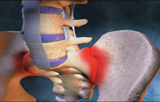 Spondylathrite ankylosante