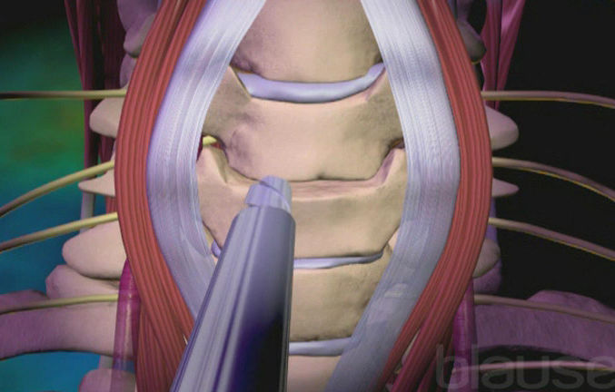 Chirurgie des cervicales