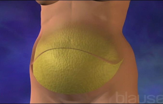 Abdominoplastie ou lipectomie