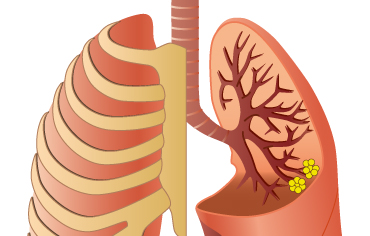 La transplantation pulmonaire