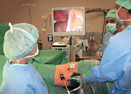 Laparoscopie chez le donneur vivant Laparoscopie chez le donneur vivant