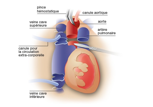 Ablation du coeur malade chez le patient receveur