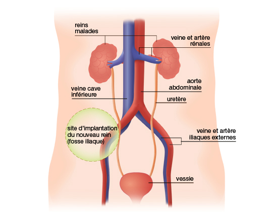 Situation initiale chez le patient receveur Situation initiale chez le patient receveur