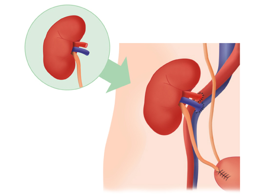 Implantation du nouveau rein chez le patient receveur Implantation du nouveau rein chez le patient receveur
