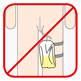 Illustration Ni drain ni cathéter Illustration Ni drain ni cathéter