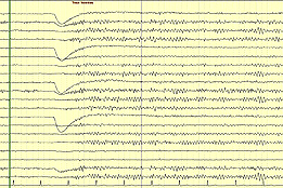 Un tracé normal EEG chez un jeune adulte Un tracé normal EEG chez un jeune adulte