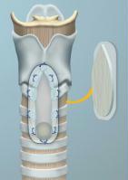 reconstruction laryngo-trachéale avec greffe de cartilage reconstruction laryngo-trachéale avec greffe de cartilage