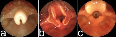 laryngomalacie laryngomalacie