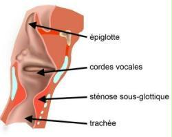 stenoses larynx stenoses larynx