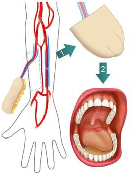 Schéma d'une reconstruction de la langue avec un lambeau libre
