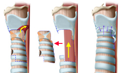Schéma de résection crico-trachéale Schéma de résection crico-trachéale