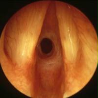 stenose sous-glottique stenose sous-glottique