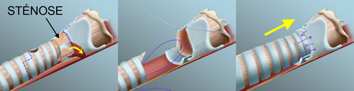 ttt stenose ttt stenose