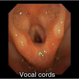 Photo des cordes vocales