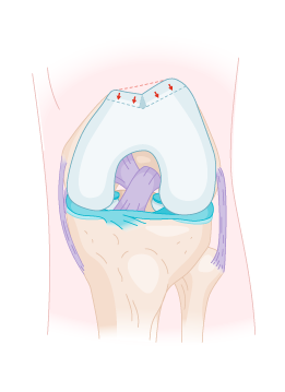 genou-instabilite-rotulienne_trochleoplastie