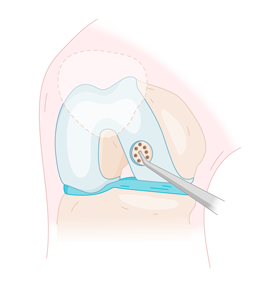 otr-genou-lesion-cartilage_microfractures