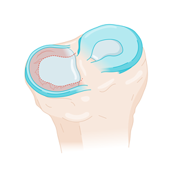 otr-genou-menisques_transplantation-avant